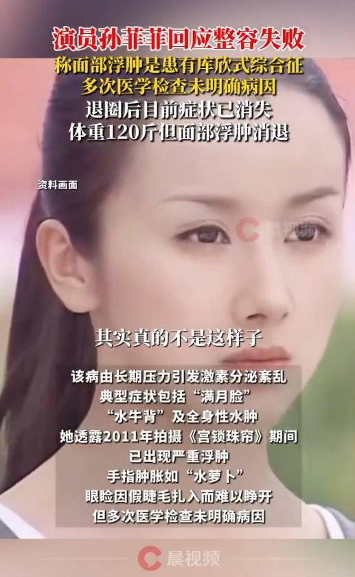 演员孙菲菲回应整容失败！称容貌变化是因为患“库欣式综合征”